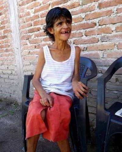 El drama de Blanquita, la mujer que de tan fr�gil apenas puede caminar