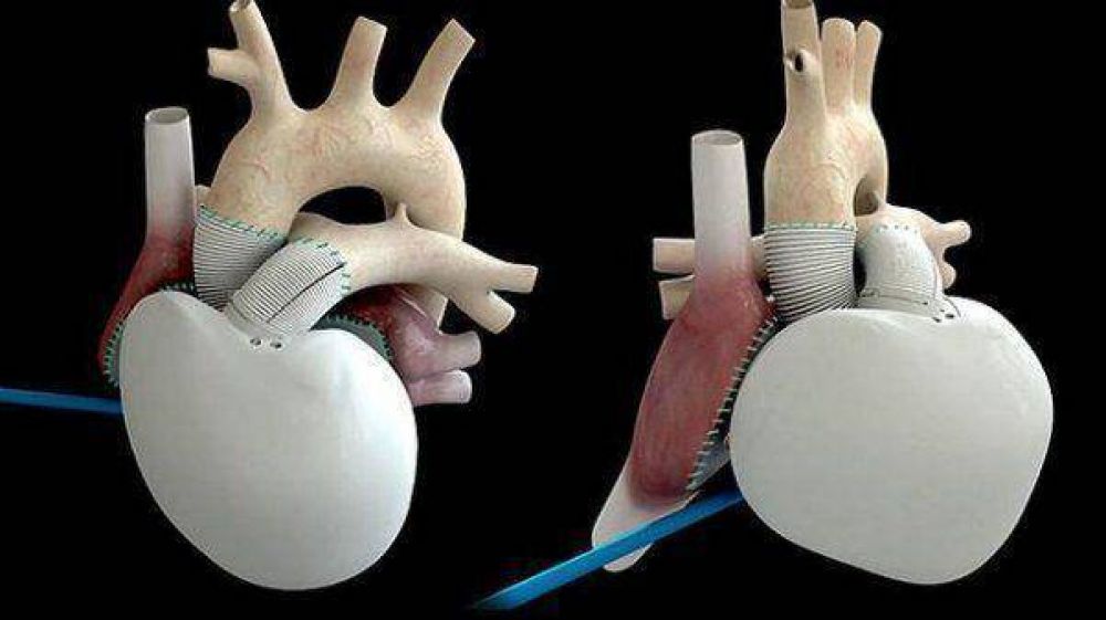 Falleci� el paciente que recibi� el primer coraz�n artificial