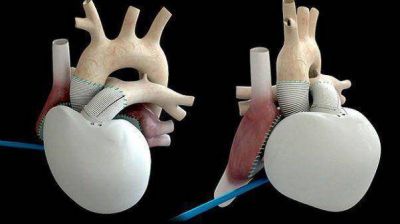 Falleci� el paciente que recibi� el primer coraz�n artificial