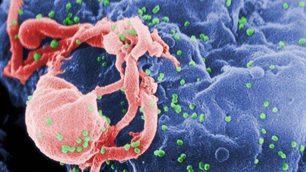 Identifican un caso �nico de transmisi�n de Sida entre mujeres