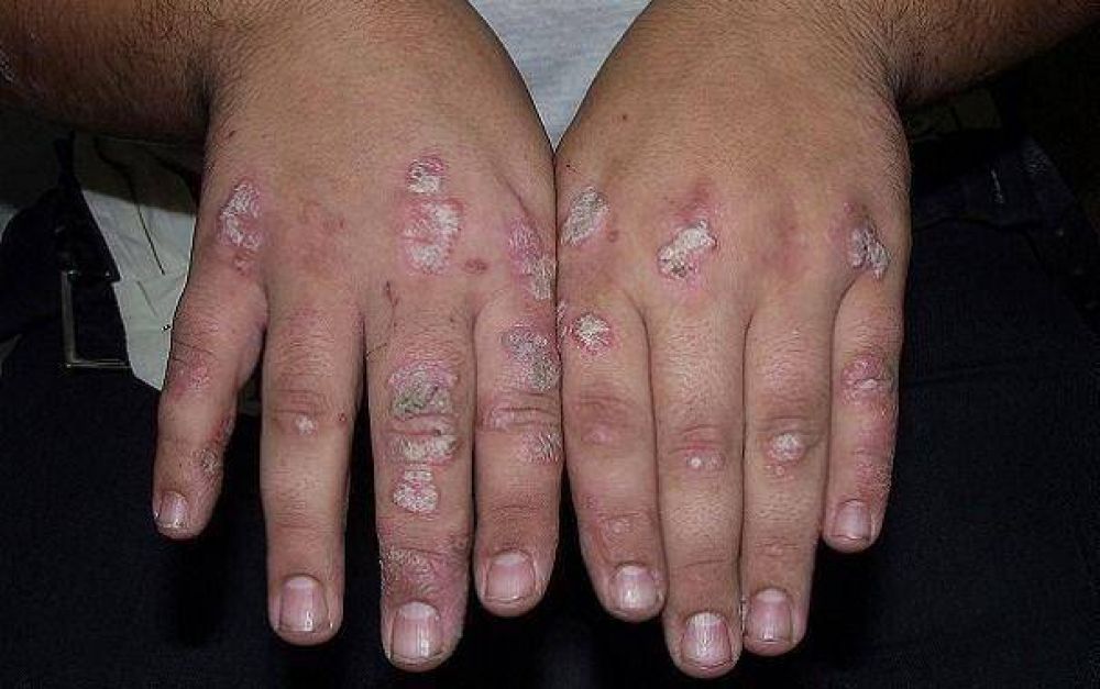 Crear�n un registro de pacientes con psoriasis