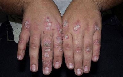 Crear�n un registro de pacientes con psoriasis