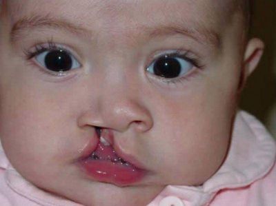 Especialistas del Hospital realizan excelentes trabajos con nenes que padecen fisuras labiales severas