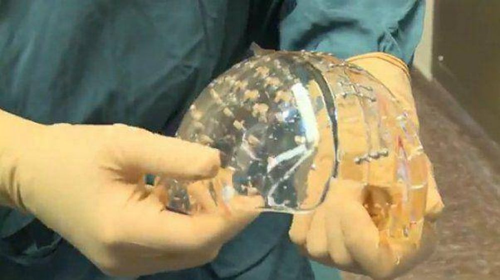 Sustituyen el cr�neo de una mujer con uno pl�stico impreso con tecnolog�a 3D