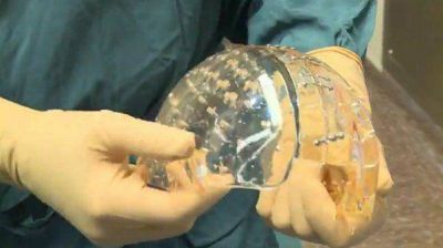Sustituyen el cr�neo de una mujer con uno pl�stico impreso con tecnolog�a 3D