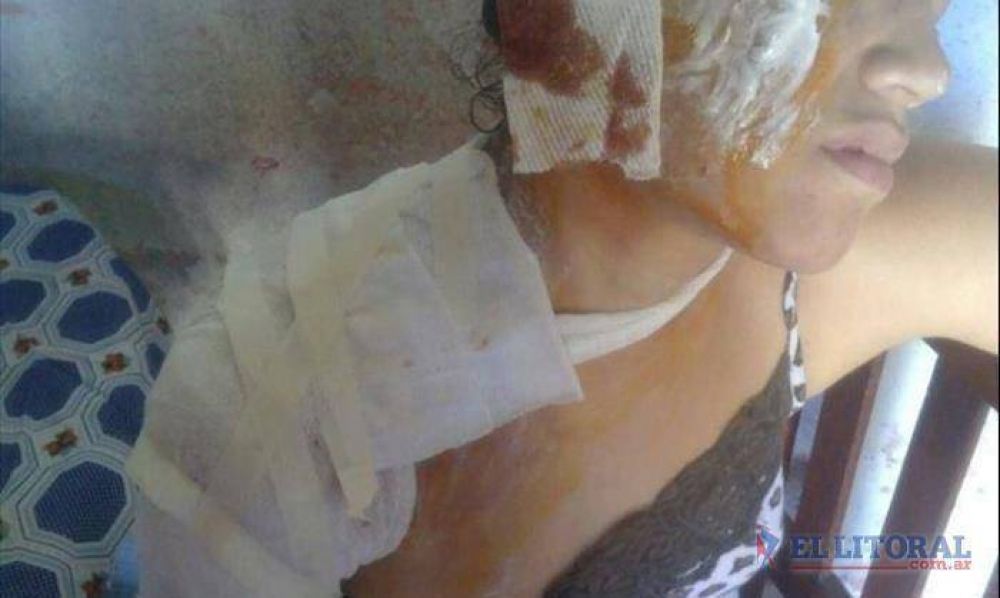 Para robarle a una chica le arrojaron agua hirviendo y le quemaron el rostro