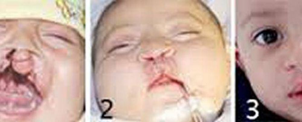 Piden m�s servicios para operaciones de labio leporino