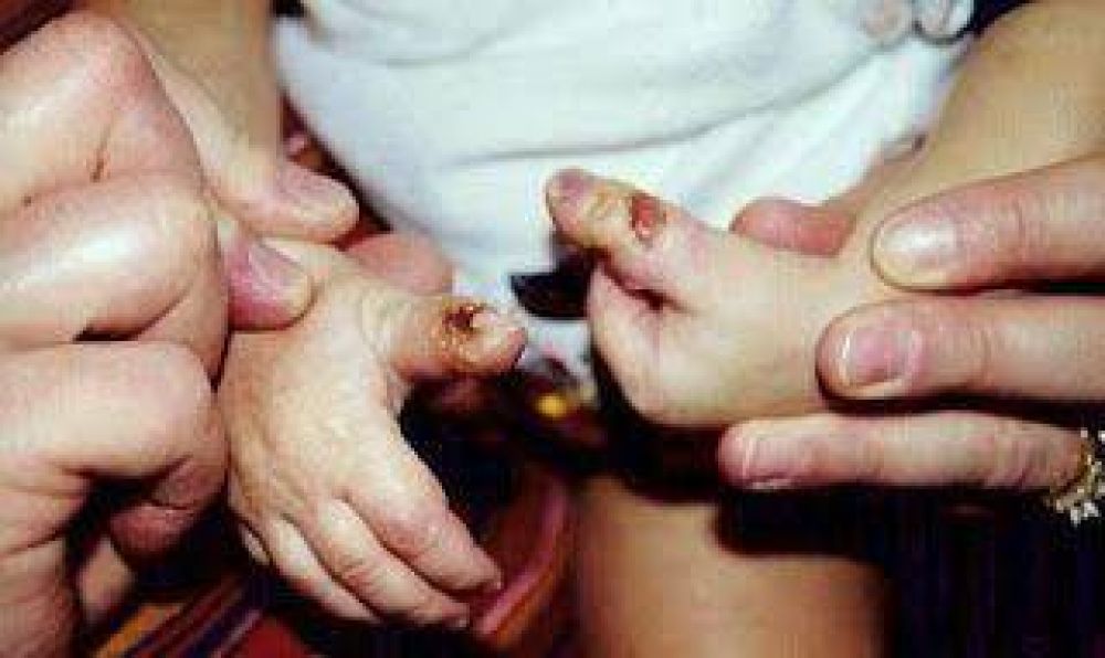 Acuerdan tratamiento a un ni�o con insensibilidad cong�nita del dolor 