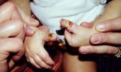Acuerdan tratamiento a un ni�o con insensibilidad cong�nita del dolor 