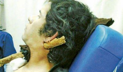 Impactante: cay� de su moto y se incrust� una rama en el cuello