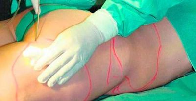 Pese a las pol�micas por el metacrilato, aumentan las cirug�as est�ticas