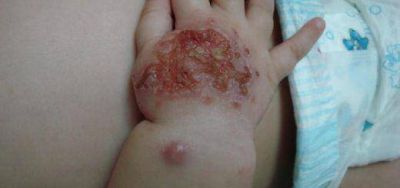 Comienza en Puerto Iguaz� el Simposio internacional sobre leishmaniasis