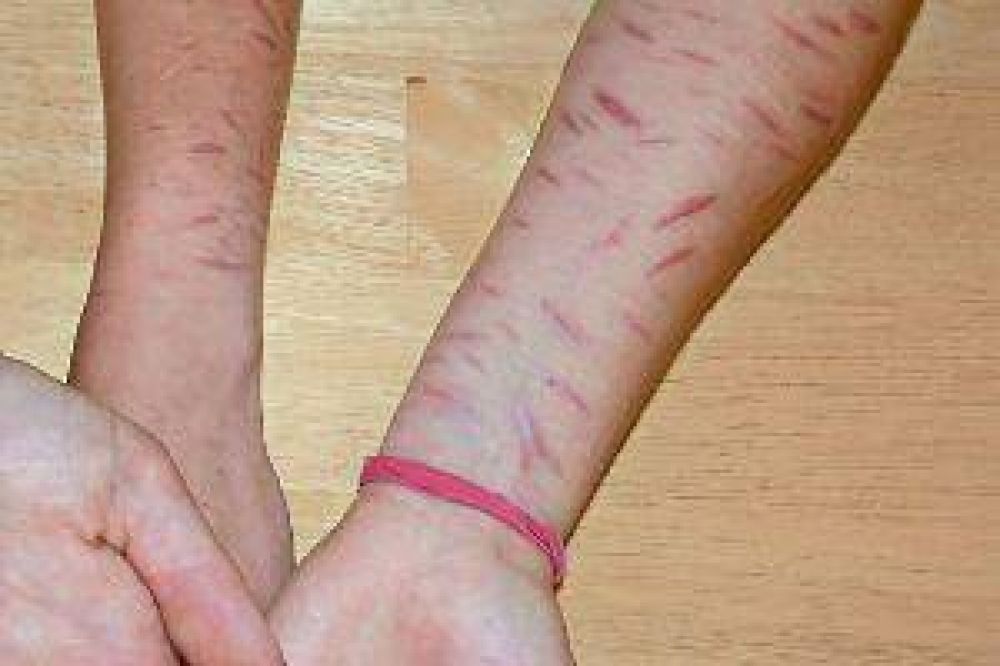 Alarma en colegios de nuestra ciudad por adolescentes que se hacen cortes en los brazos