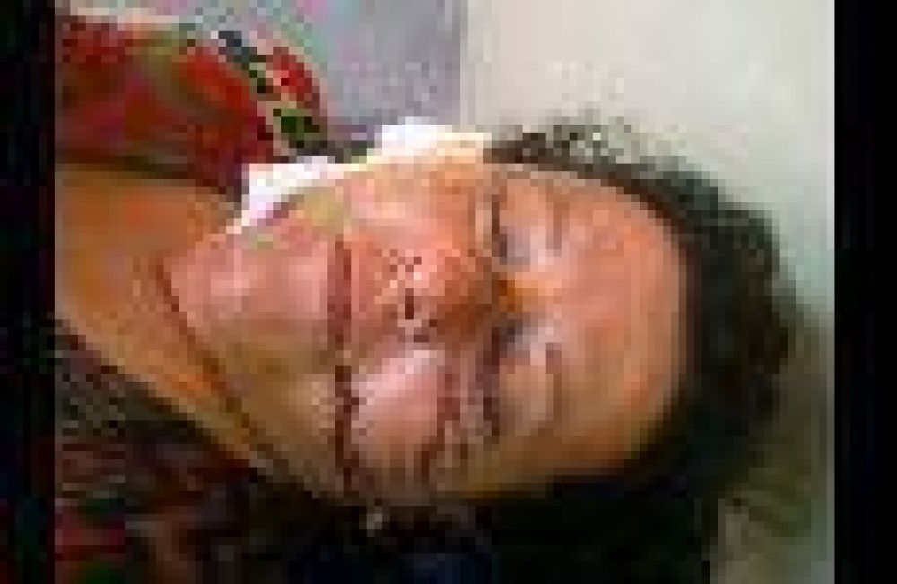 Las Heras: un hombre quem� a su ex pareja con agua hirviendo y luego la apu�al� en la cara