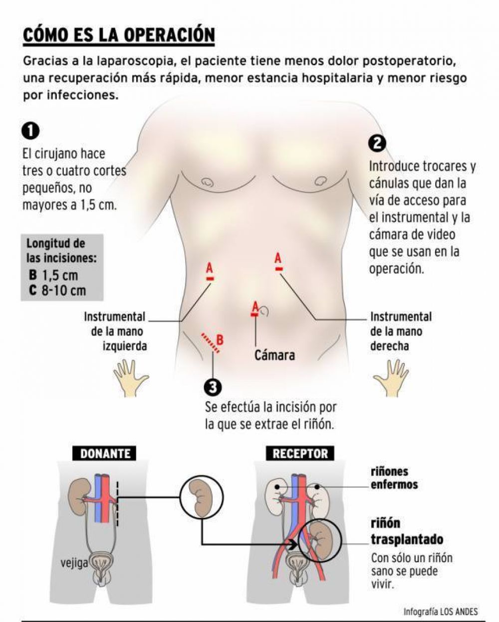Logran practicar ablacin de rin por laparoscopia