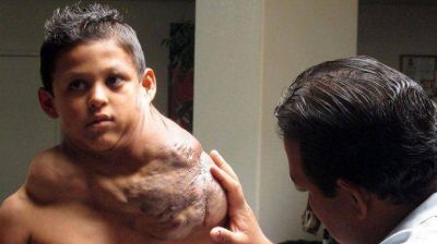 Extirparon un gigantesco tumor a un ni�o mexicano en EEUU