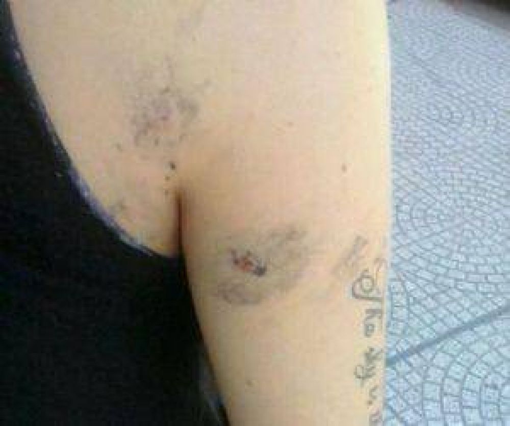 Una madre denunci� que su hija sufri� lesiones por el uso de pirotecnia en la Escuela Normal
