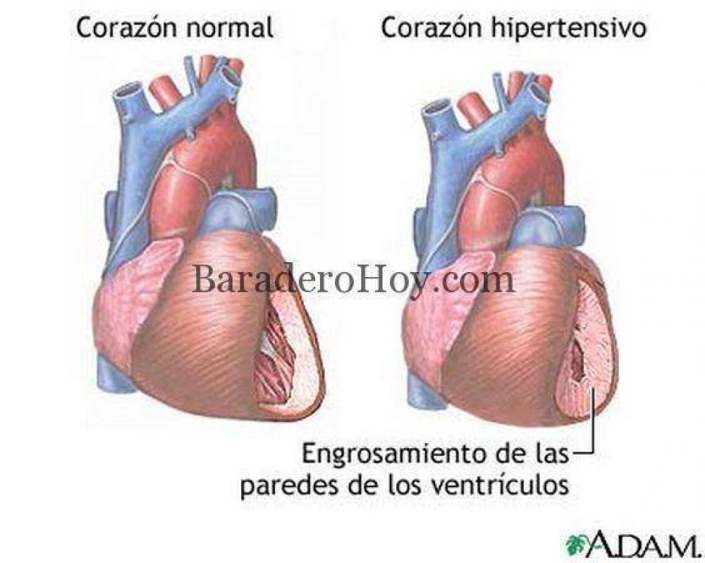 Convocatoria para periodistas: D�a Mundial de la Hipertensi�n Arterial.