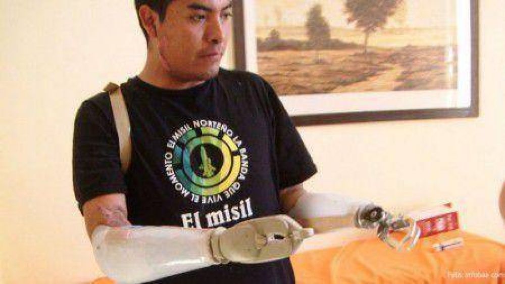 Implantan pr�tesis �bi�nicas� en ambos brazos a un joven juje�o