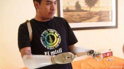 Implantan pr�tesis �bi�nicas� en ambos brazos a un joven juje�o