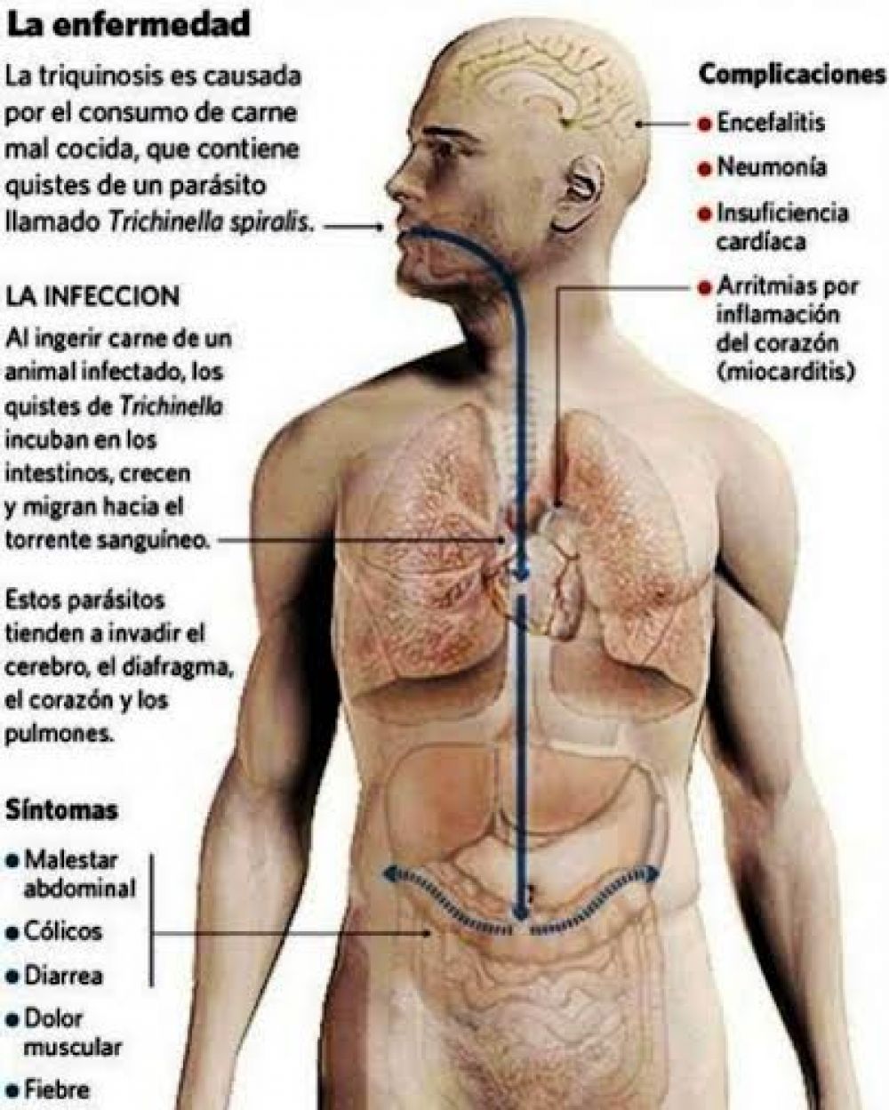 Alerta por posibles casos de triquinosis