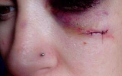 Su ex le deform� la cara y ella lo denunci� en Facebook