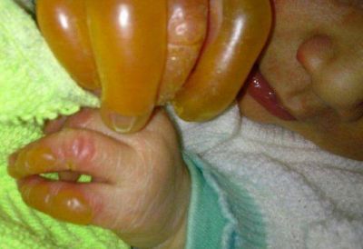Con tan solo pocas horas de nacida, una beb� fue quemada con un caloventor en el quir�fano