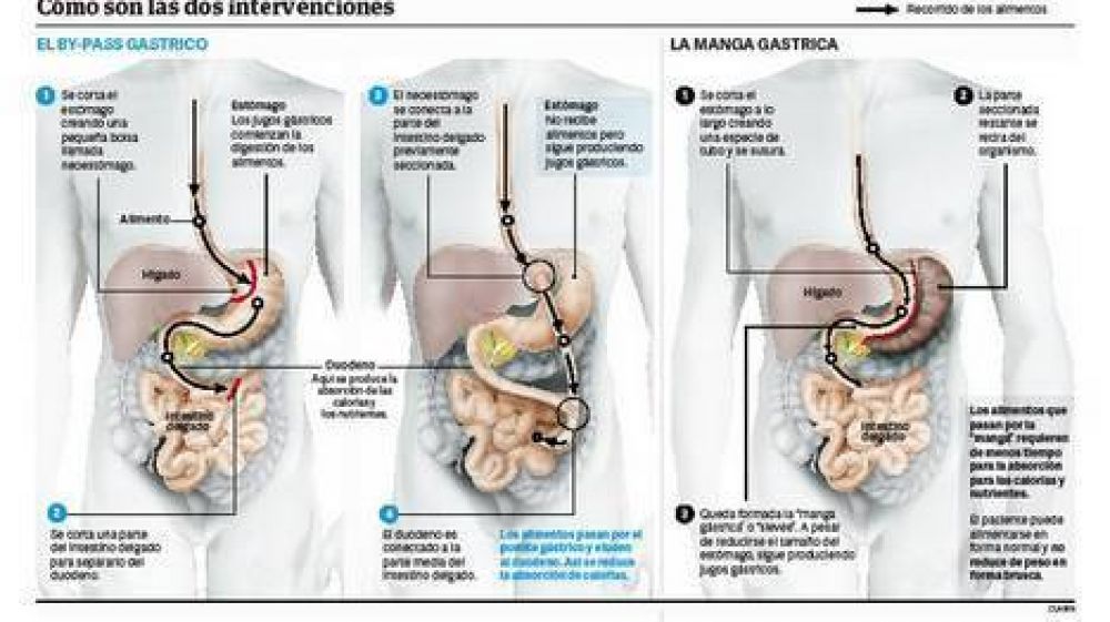 Tres de cada 10 obesos que se operan engordan de nuevo