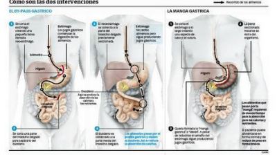 Tres de cada 10 obesos que se operan engordan de nuevo