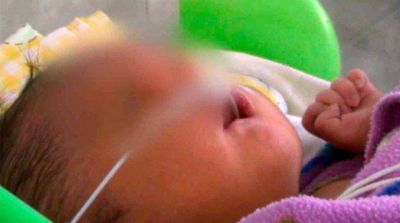 Conmoci�n en Per� por el nacimiento de un beb� con dos narices