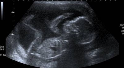 Aborto en Estados Unidos: Presidente del Episcopado pide proteger organizaciones pro-vida