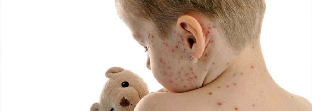 Preocupacin por casos de varicela: Hay 20 casos en Chilecito
