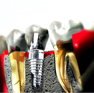 Ingenieros de la UNLP trabajan para mejorar el material de los implantes dentales