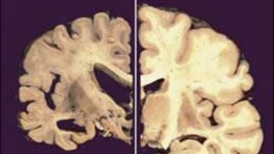 Desarrollan dos f�rmacos que frenar�an el deterioro en las enfermedades neurodegenerativas