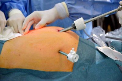 Mendoza: cada a�o hay 20% m�s de cirug�as bari�tricas