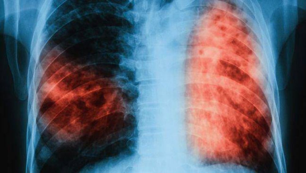 Tuberculosis: impacto en el GBA Sur