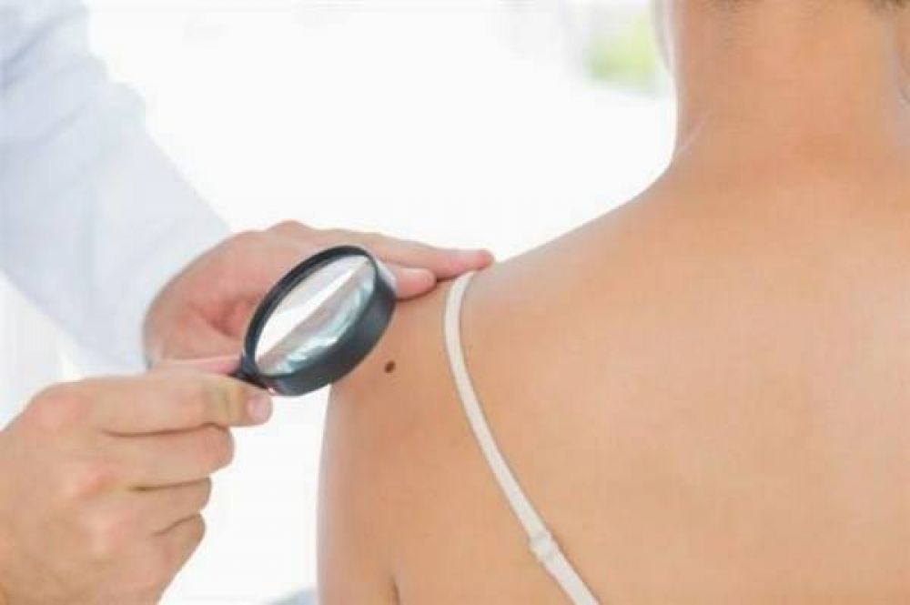La UBA inicia una campaa de deteccin de lunares para prevenir el cncer de piel