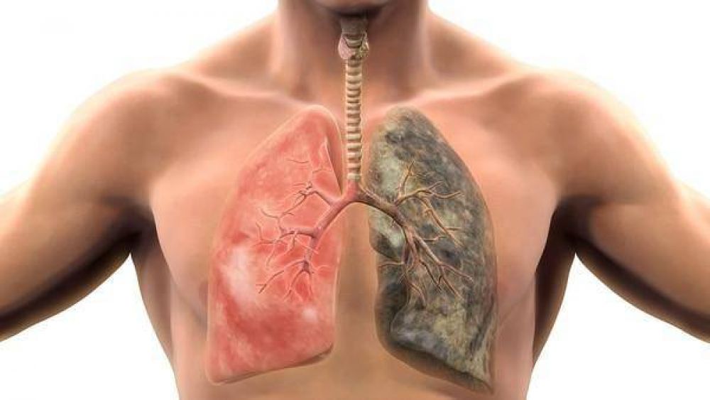 El ms mortal de todos: tres vidas por minuto se cobra el cncer de pulmn