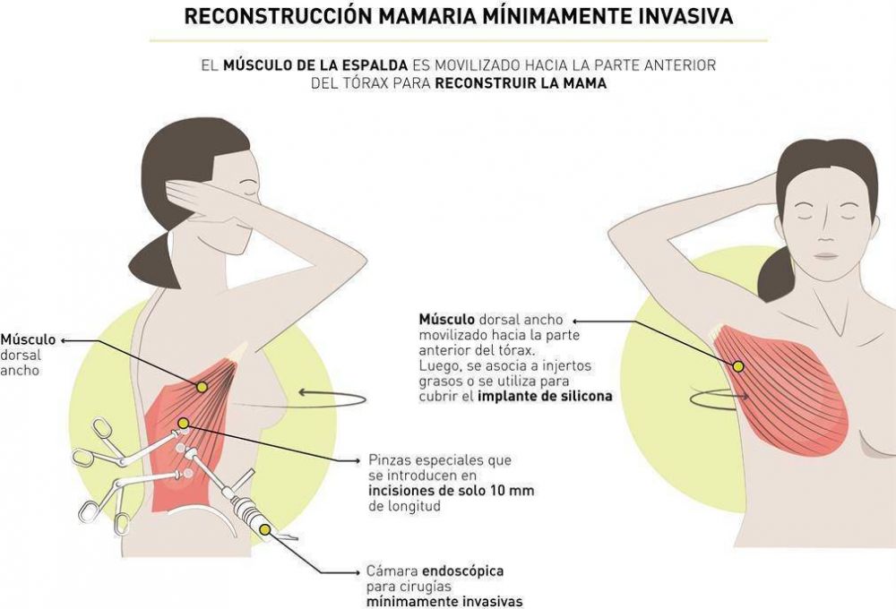 Por primera vez, realizaron una reconstrucci�n mamaria por via endosc�pica