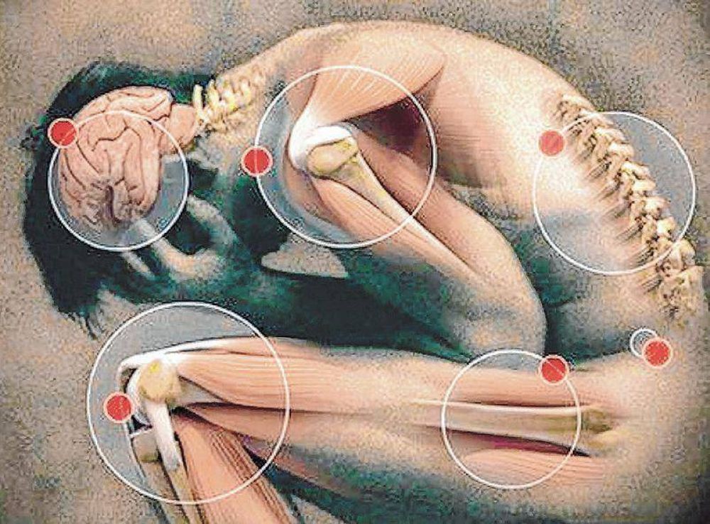 A las personas con fibromialgia les toma hasta diez a�os dar con la causa del dolor