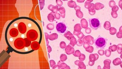 Aprueban en Argentina un nuevo tratamiento para un tipo com�n de leucemia