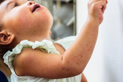 Sarampi�n: intensifican la vigilancia epidemiol�gica de la enfermedad
