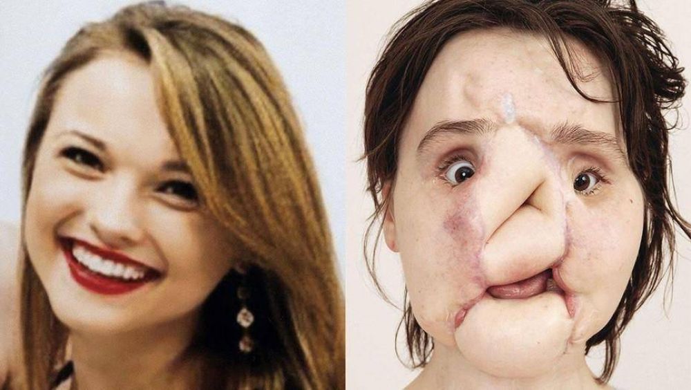 La historia de la mujer ms joven en recibir un trasplante de cara