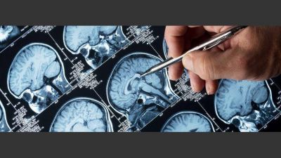 Epilepsia: con la medicaci�n adecuada, el 70% de los pacientes deja de tener crisis