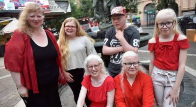 Albinos piden ser incluidos en el Programa M�dico Obligatorio