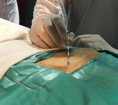 El Hospital San Juan de Dios de La Plata realiz� por primera vez una in�dita intervenci�n card�aca