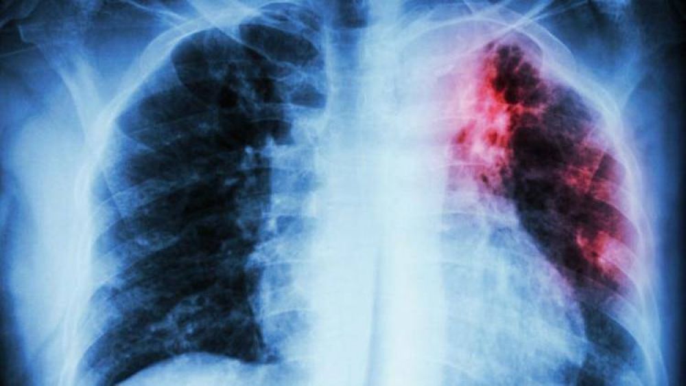 Tuberculosis: una enfermedad cada vez ms mortal en Argentina
