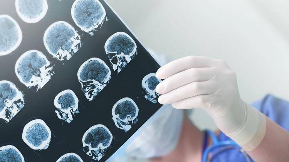 Por primera vez, buscaron identificar el riesgo gen�tico de padecer Alzheimer en casi mil argentinos