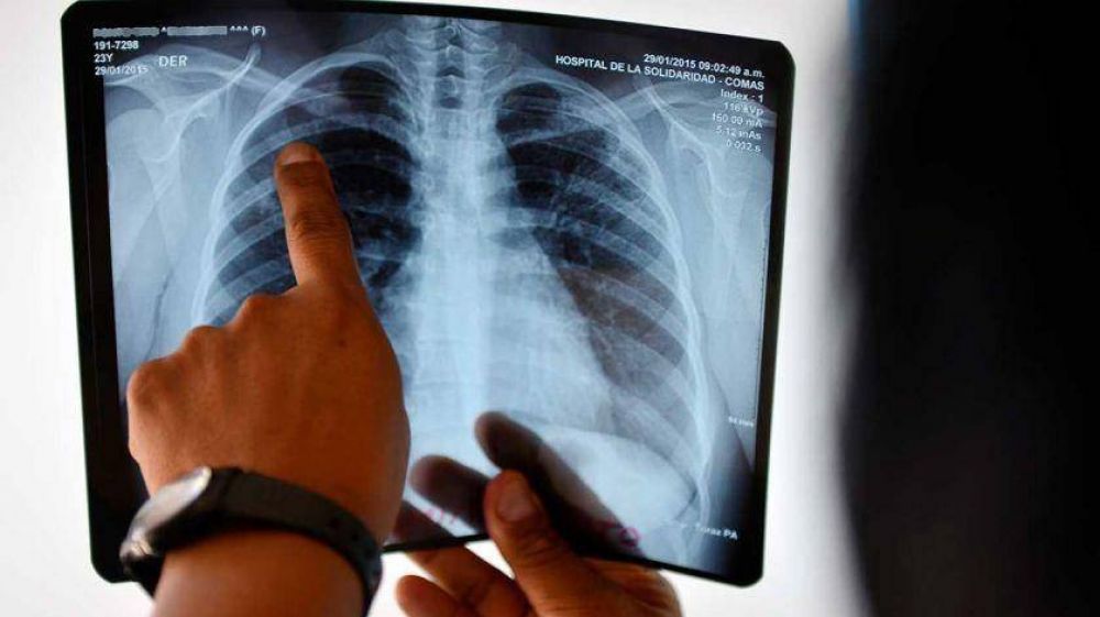 Nuevo caso de tuberculosis en Provincia: cmo se previene y cules son los riesgos