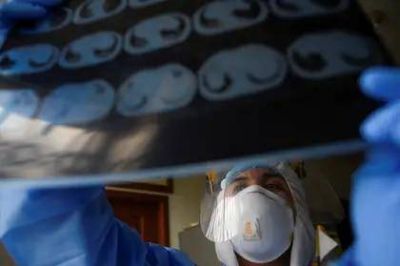Qu� es la hipoxia silenciosa, el mal que afecta a algunos pacientes con coronavirus y que puede ser letal